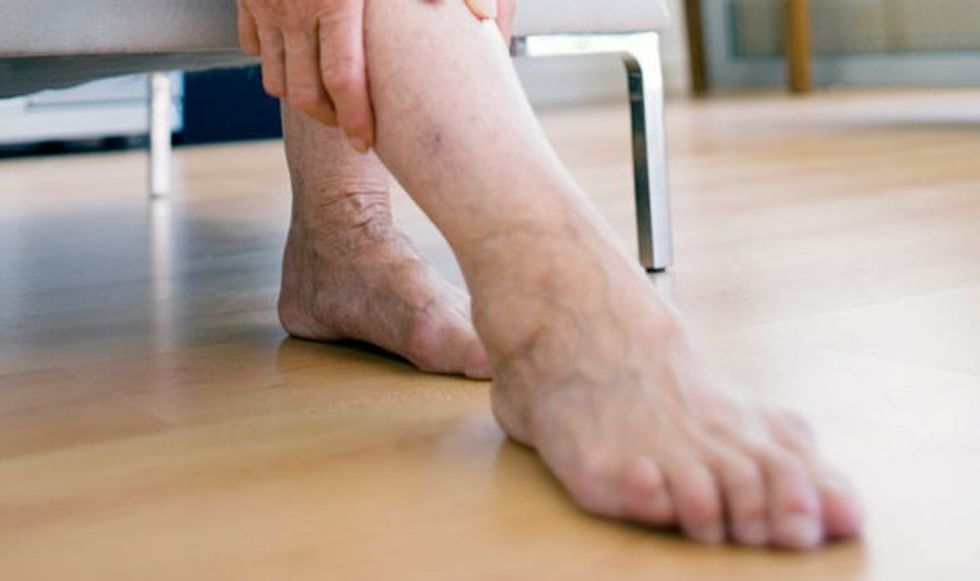 Deep vein thrombosis DVT can stay in the leg and not move 919721