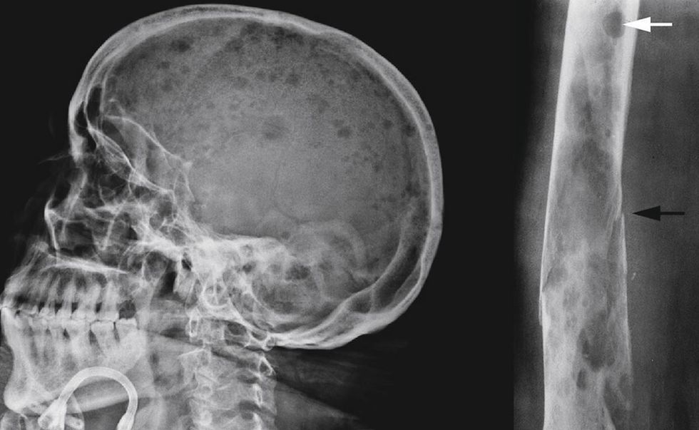 Demtimet kockore ne Mieloma Multiple