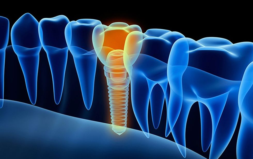 dentalimplantsexample