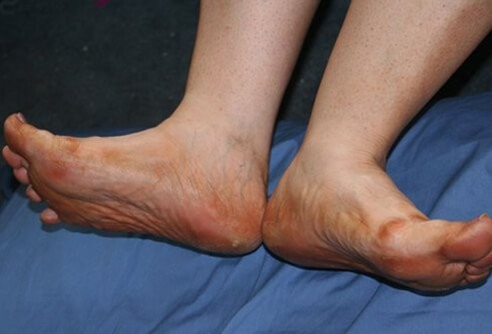 diabetes foot problems s3 vascular
