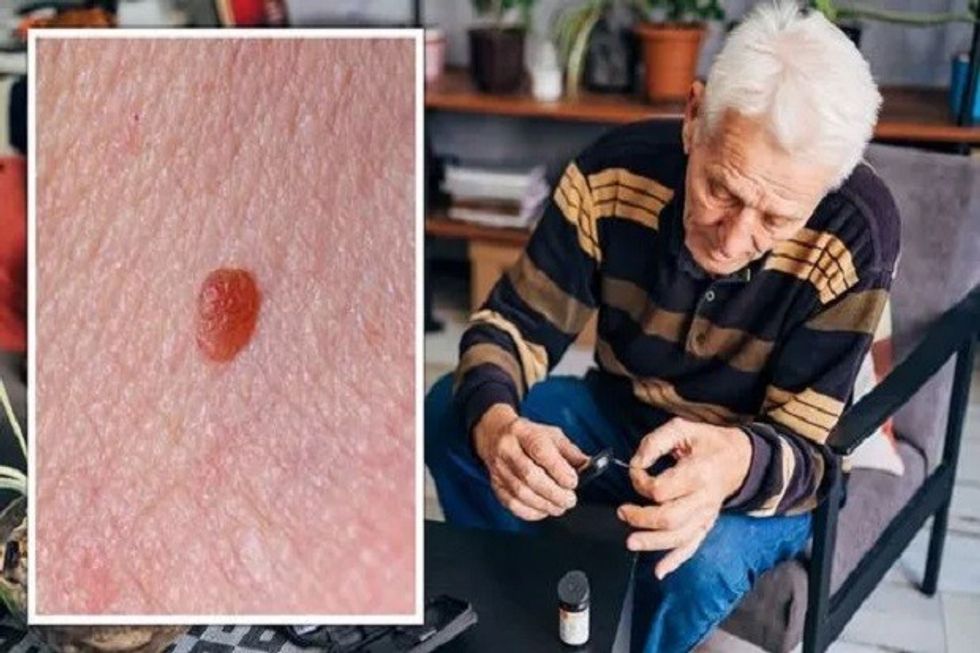 diabetes tipe 2 perubahan di kulit