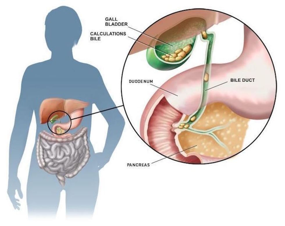 did-you-know-that-you-can-discharge-gallstones-through-the-stools