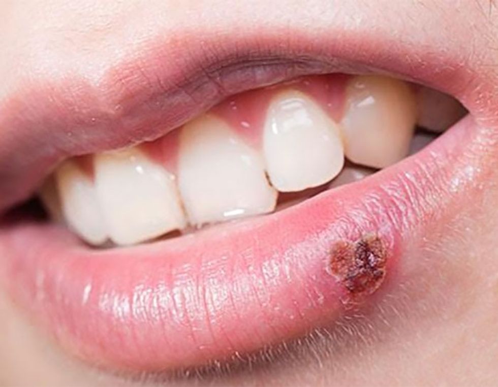 diseases-you-can-get-by-kissing2