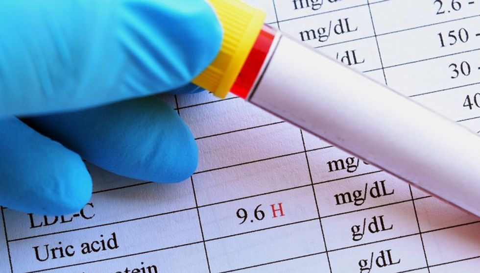 dt 180829 high uric acid lab test result