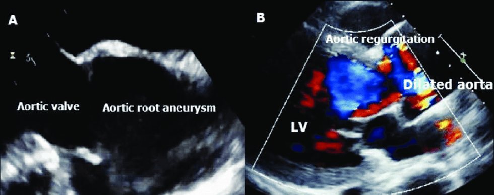 Echocardiography shows aortic valve insufficiency and aortic root enlargement