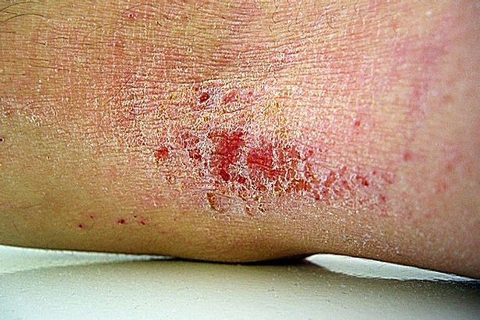 Eczema close up