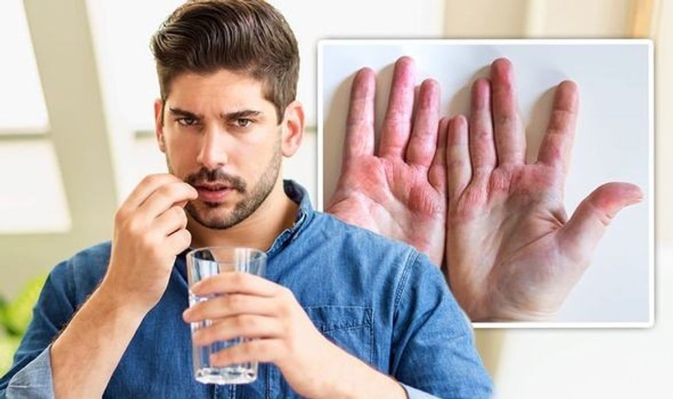 Eczema Could prebiotics and probotics help 1411762