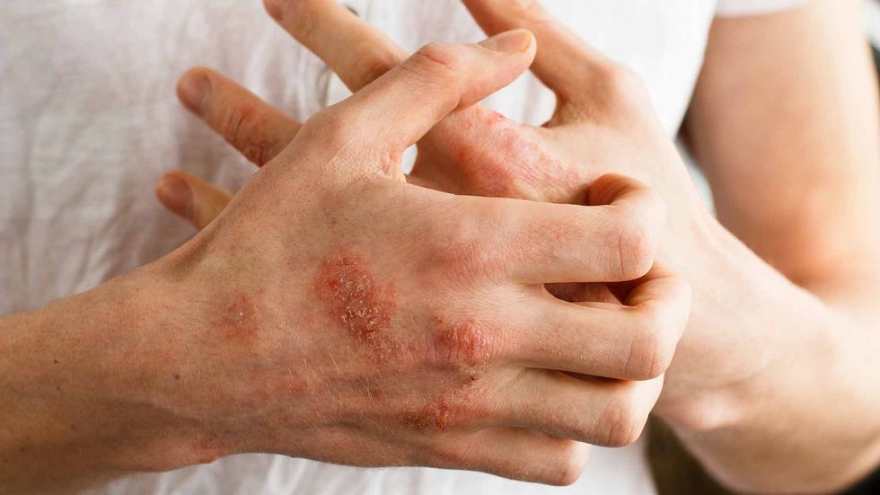 Eczema psoriasis skin disease red itchy patches dry cracked bumps natural remedies