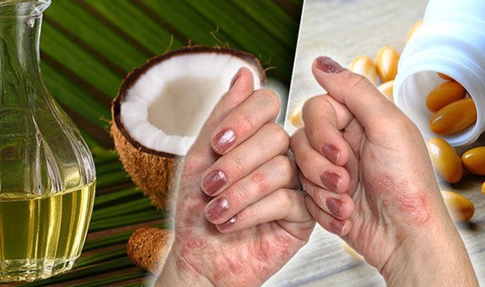 eczema treatment dry skin coconut oil vitamin 1002735