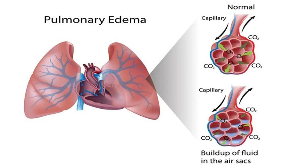 Edema pulmonare