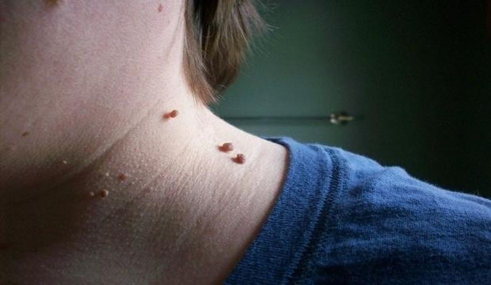 Eliminoni lythat nga lëkura në qafë