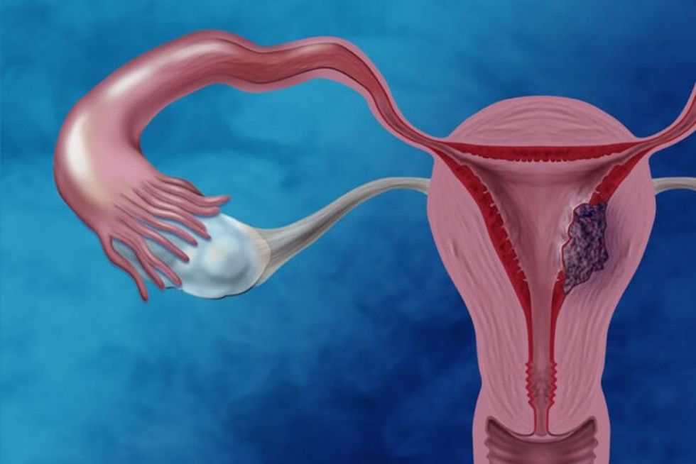 EndometrialCancerIllustration 1