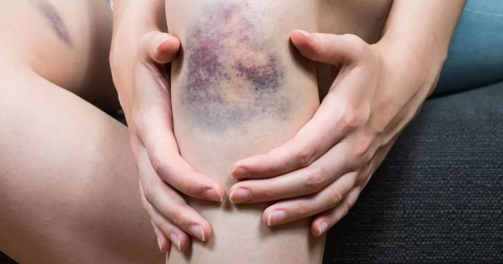 purpura disease edited