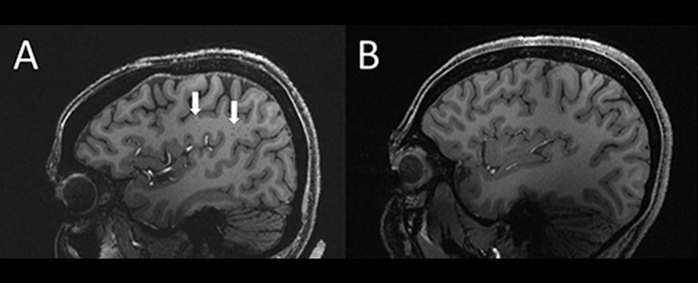 enlarged perivascular spaces