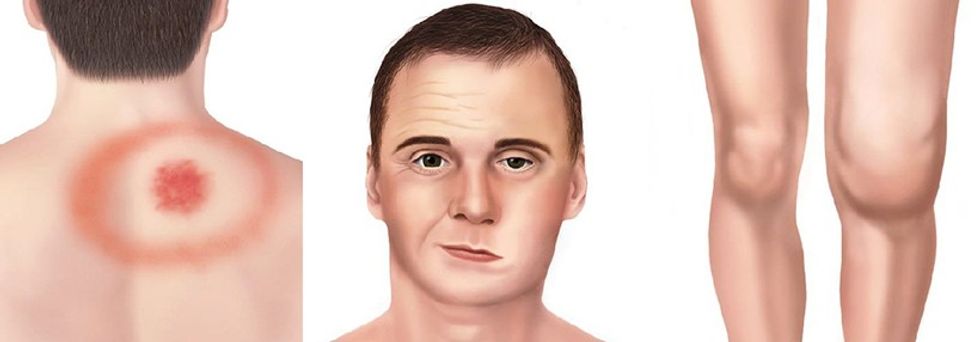 Erythema migrans, paralizë e fytyrës, ënjtje e nyjave – disa prej simptomave të sëmundjes Lyme.