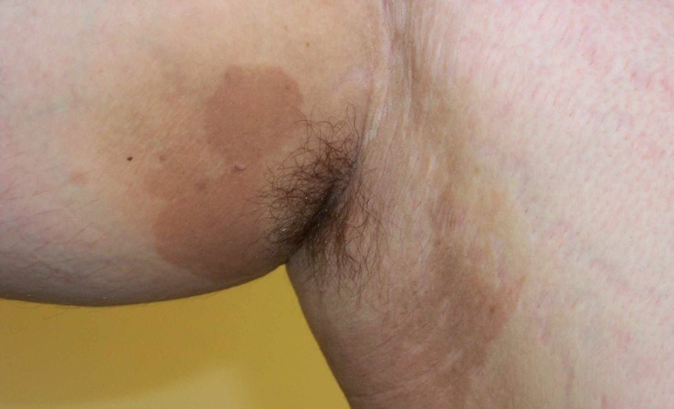 erythrasma02 3895772d5fbd4d619e9ccbf998f511d6 edited