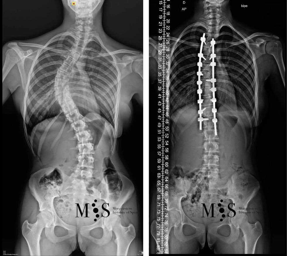 escoliosis pre post 2 scaled