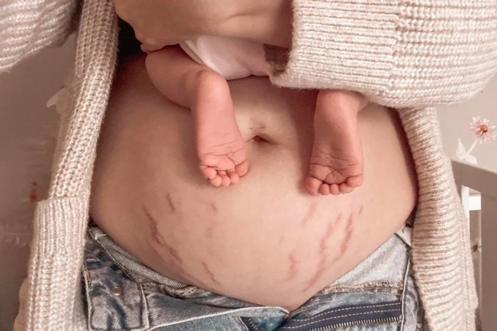everything you need to know about stretch marks header