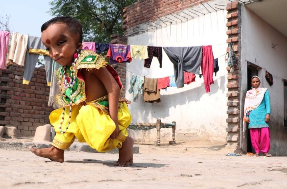 *** EXCLUSIVE - VIDEO AVAILABLE *** JALANDHAR, INDIA - OCTOBER 27: Pranshu is seen walking near his house on October 27, 2016 in Jalandhar, India. A SIX-YEAR-OLD Indian boy is worshiped by locals who believe he is the reincarnation of the Hindu god Ganesha. Pranshu, from Jalandhar in the Indian state of Punjab, was born with a mystery medical condition that has left him with a swollen forehead and deep set, narrow eyes. Although he is unable to walk, villagers believe Pranshu is a divine child and have nicknamed him 'Lord Ganeshaí - flocking to see him outside the nearby mosque. PHOTOGRAPH BY Ajay Verma / Barcroft Images London-T:+44 207 033 1031 E:hello@barcroftmedia.com - New York-T:+1 212 796 2458 E:hello@barcroftusa.com - New Delhi-T:+91 11 4053 2429 E:hello@barcroftindia.com www.barcroftimages.com