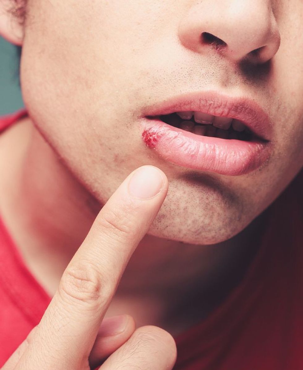 f94153f4b4ffd8bd9c8a843ddb213f16 genital herpes herpes cure