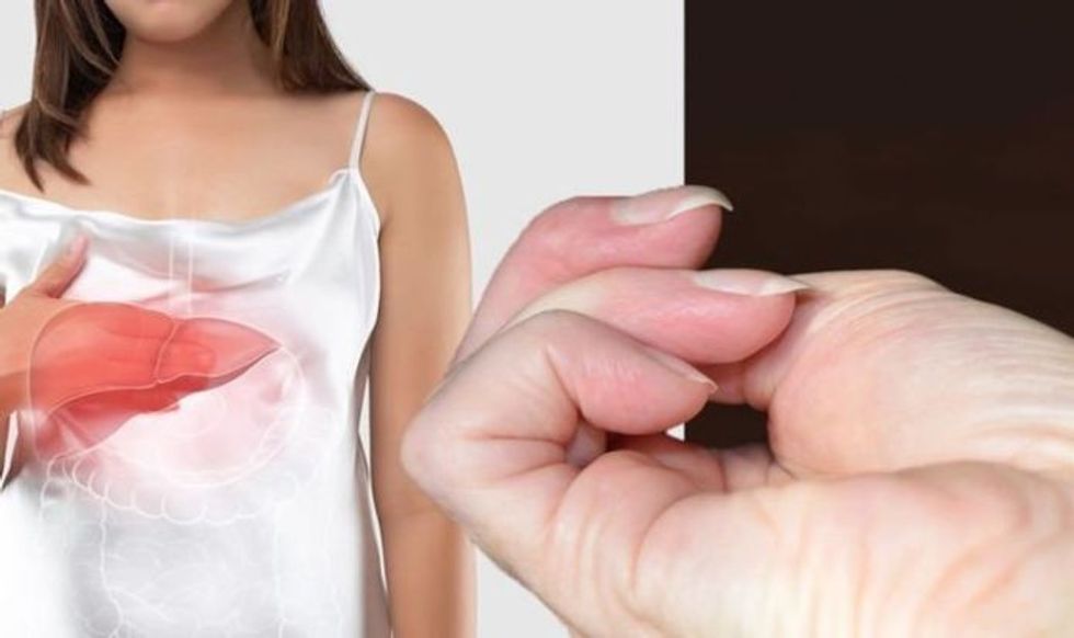 fatty liver disease symptoms nail changes are a serious warning sign what to look for