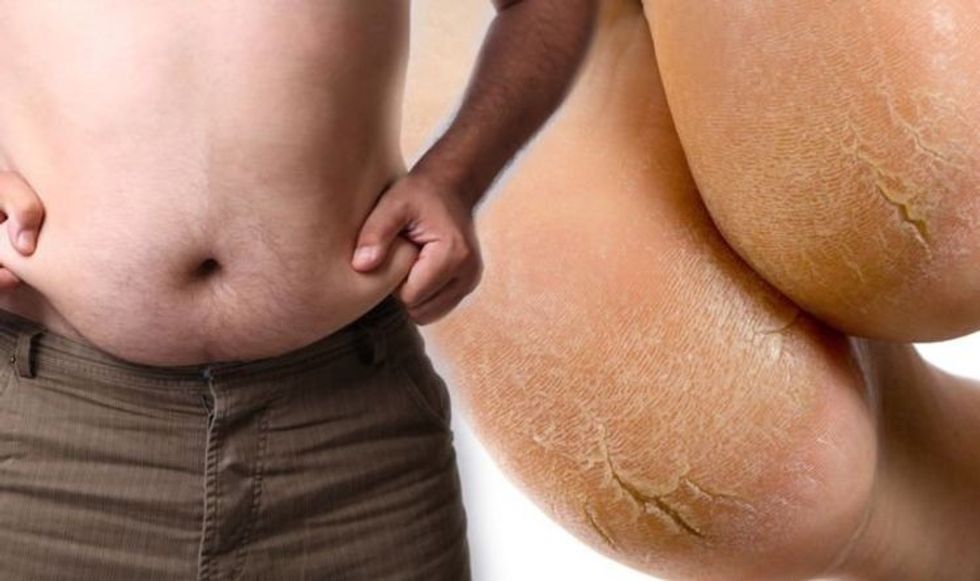 fatty liver disease three signs on the feet that may indicate your risk of the condition