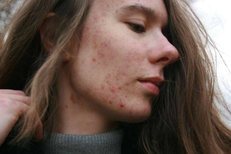 female acne spots side profile