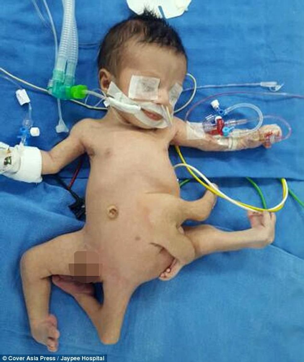 Fëmija i lindur me tetë gjymtyrë eshte operuar me sukses foto 2