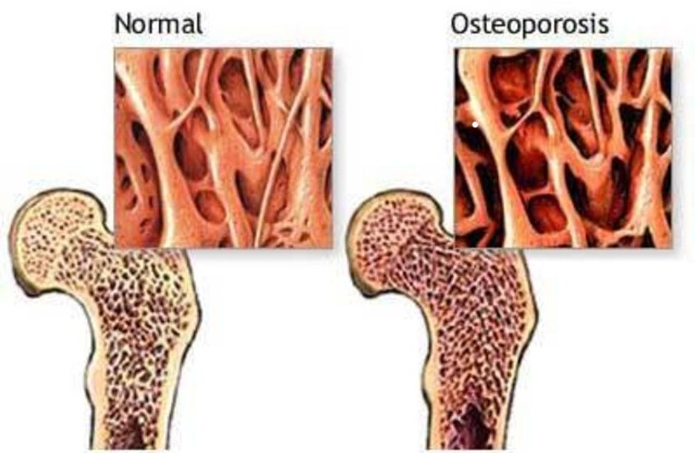 fig 2 osteoporoza(1)