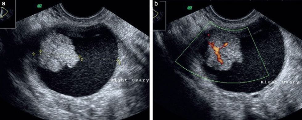 Figure 2 Ultrasound images of serous borderline tumor recurrence a Gray scale