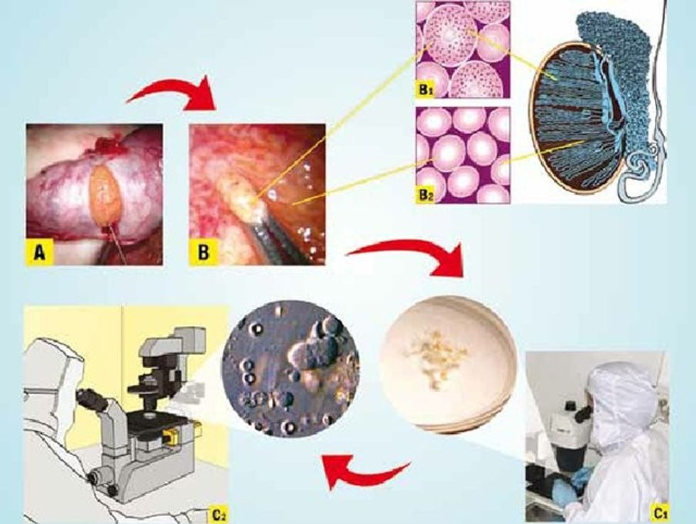 Figure 3 Microsurgical Testicular Sperm Extraction Micro TESE Operating microscope