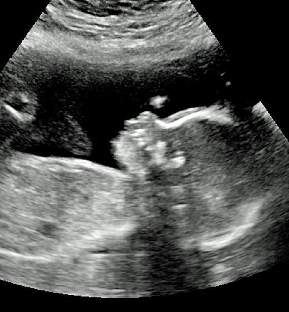 Flokët e gjatë të bebes u panë edhe në fotografinë me ultrazë foto 2