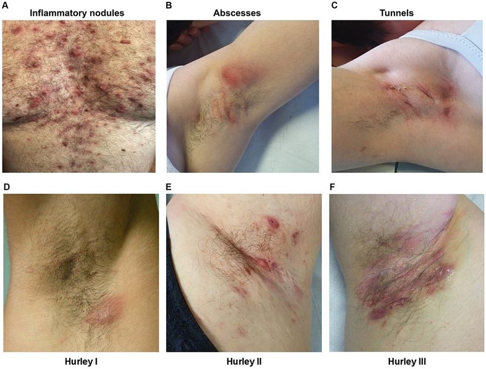 fmed 11 1403455 g001