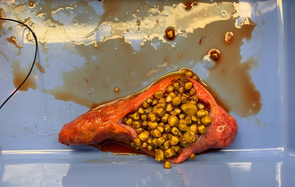 gallstones scaled