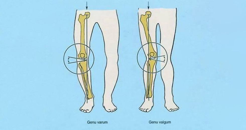 Genu Valgum Varum large