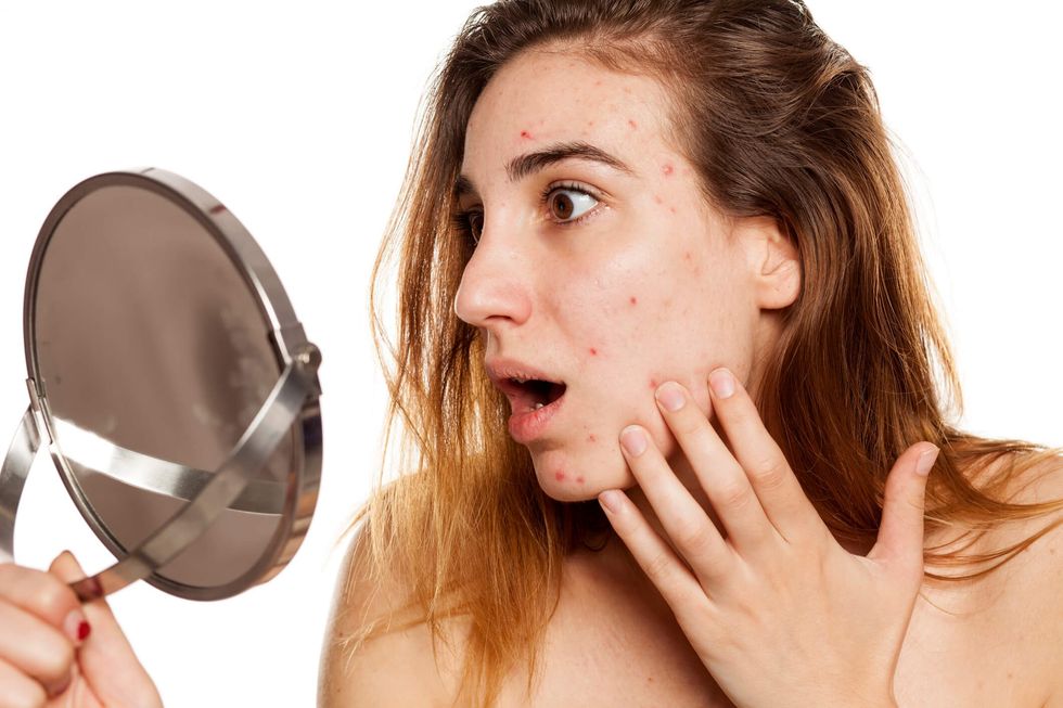 getty rf photo of young woman with acne vulgaris