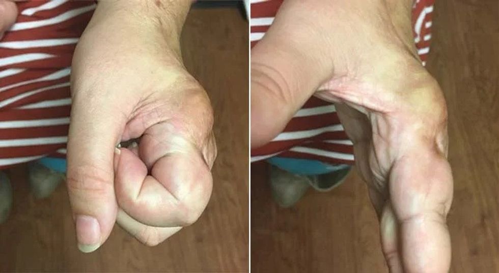 giant cell tumor of bone freezing result