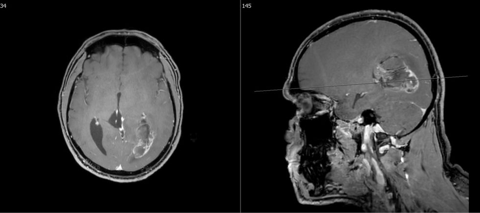 Glioblastoma parietookcipitale