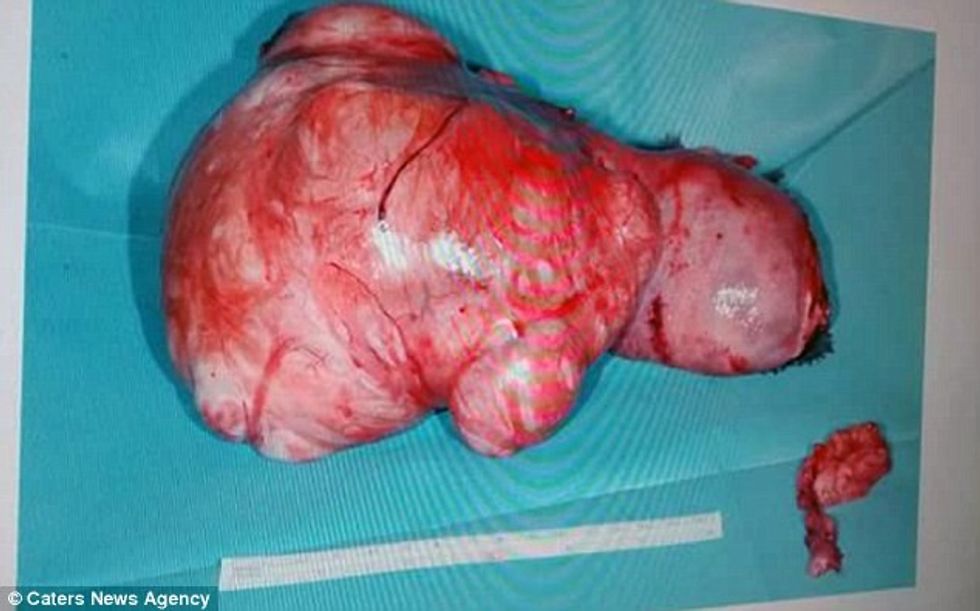 Gruas që dukej shtatzënë për tri vite i hoqen tumorin ne madhesi te shalqirit foto 3