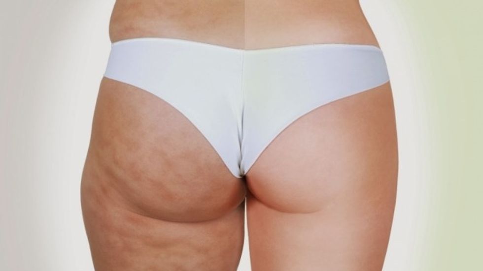 grumbullimi i ujit dhe celuliti hd