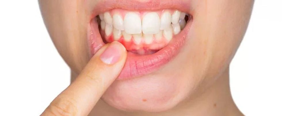 gums symptoms of peri implantis