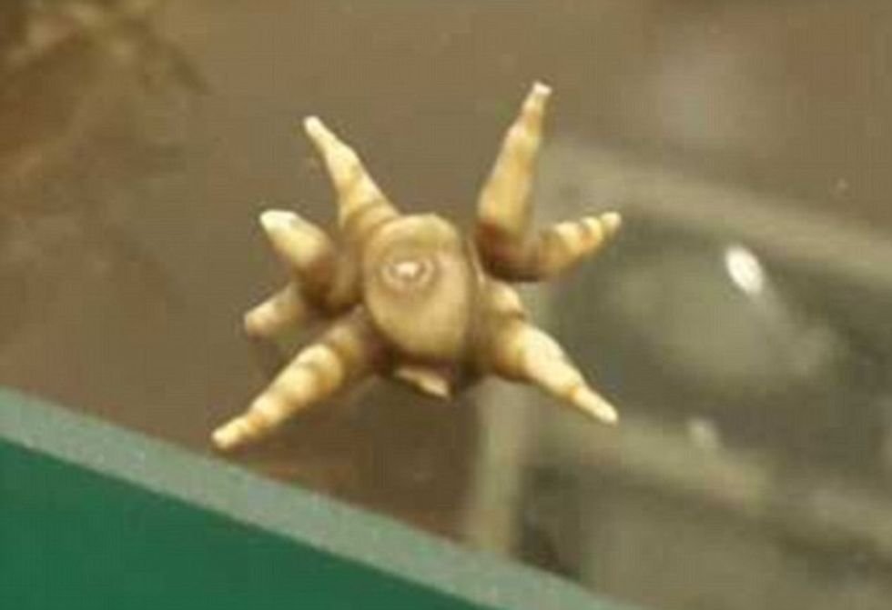 Guri gjigant me formë të pazakontë që i hoqën nga fshikëza foto 2