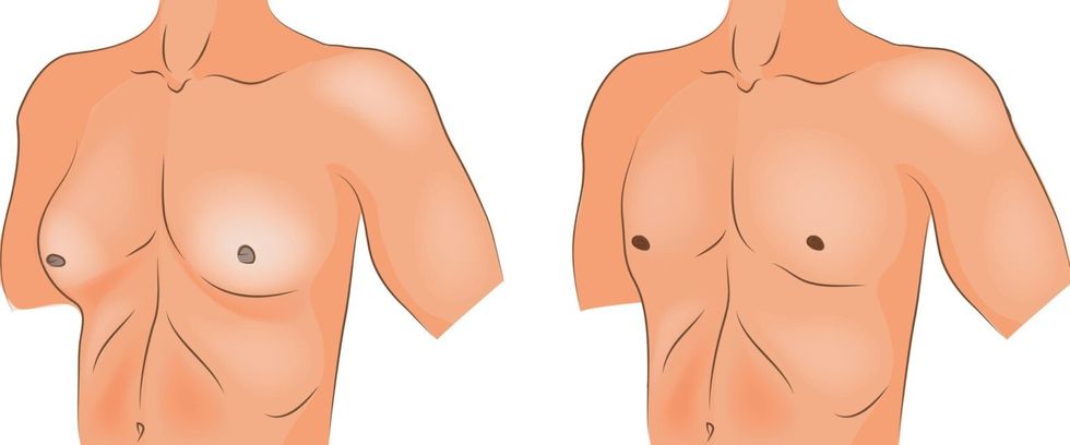 gynecomastia slika 1