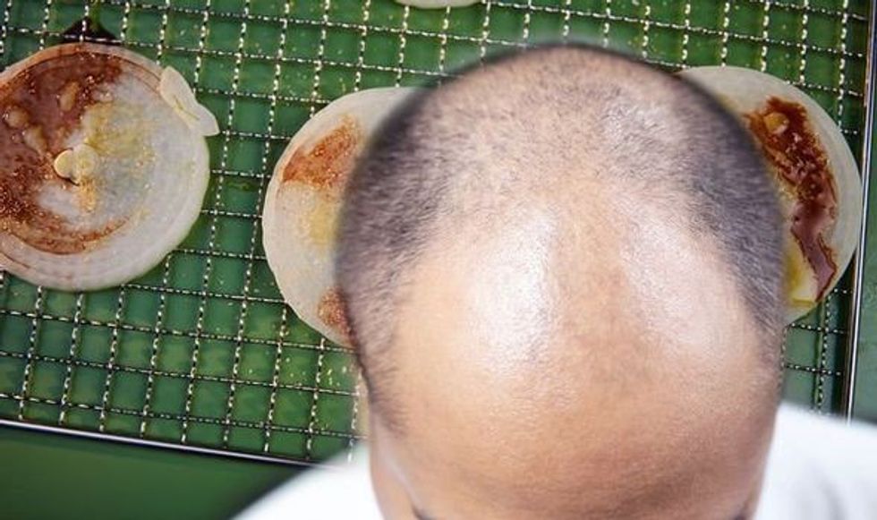 Hair loss treatment Onion juice for hair regrowth 1464743