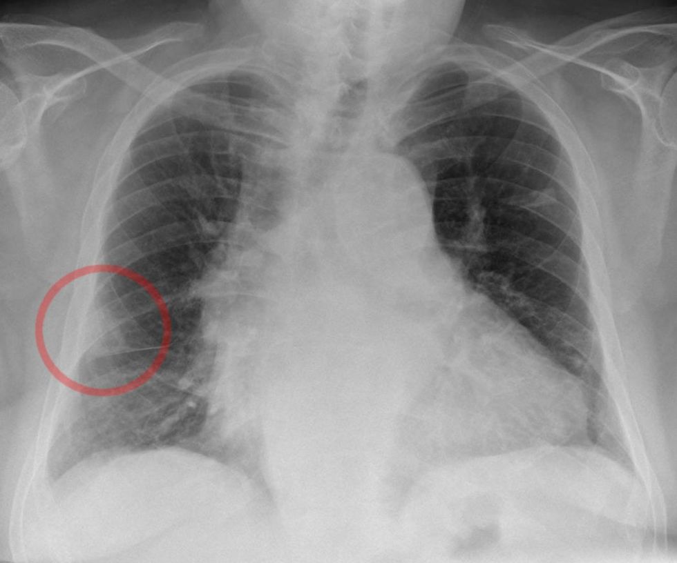 Hampton hump bei schwerer Lungenembolie Roe Thorax
