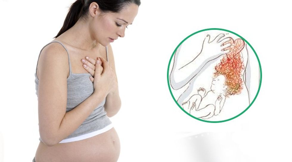 Heartburn pregnancy