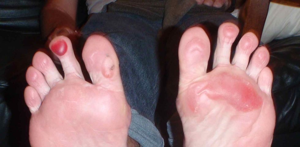 heat blisters before icing