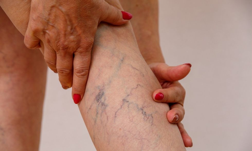 heres what we know about cbds effects on vericose veins