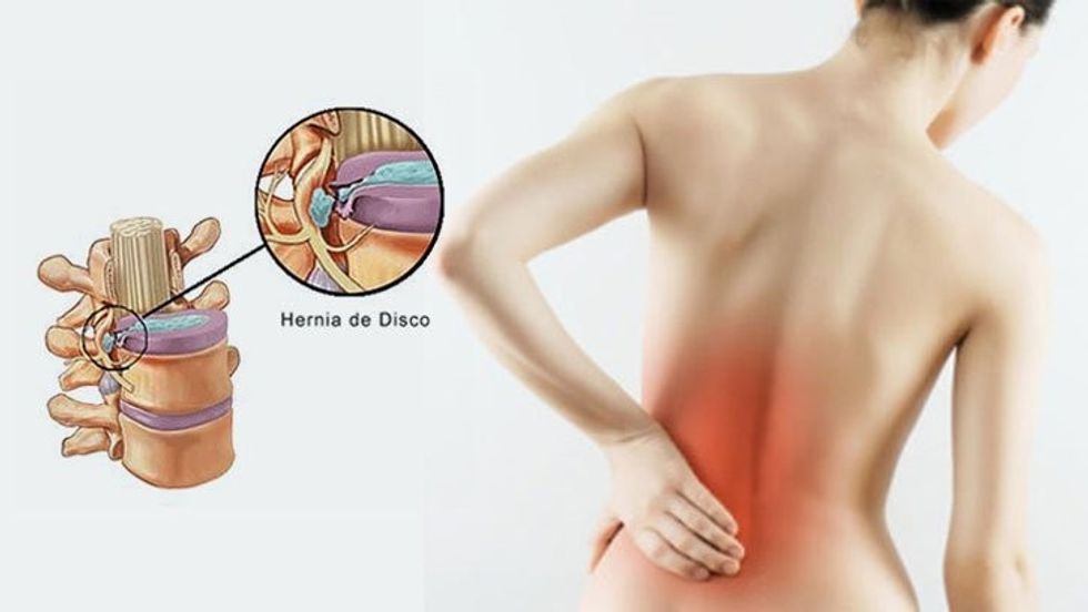 hernia discal 1
