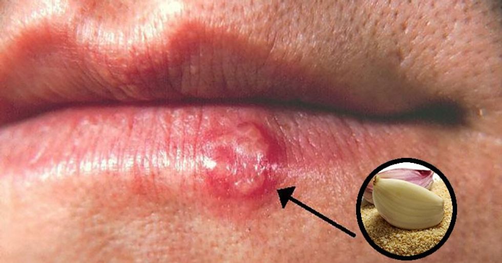 herpes simplex